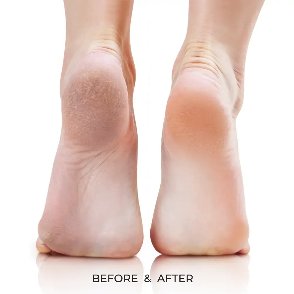 Kiss New York Dual-Sided Foot File for Callus Removal and Smooth, Soft Feet - Image 21
